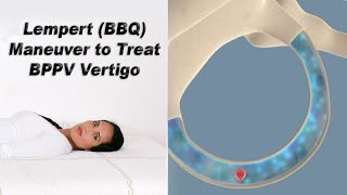 Lempert BBQ Maneuver to Treat BPPV Vertigo [upl. by Mountford]