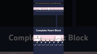 Third Degree Atrioventricular Block ECG P waves [upl. by Neelear352]