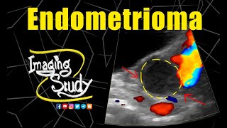 Endometrioma  Chocolate Cyst  Ultrasound  Case 224 [upl. by Eelsha417]