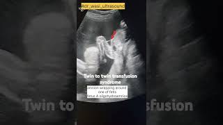 Twin to twin transfusiom syndrome ultrasound radiology obstetrics [upl. by Kohcztiy]