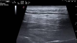 Suprascapular nerve radiofrequency ablation [upl. by Ettie]