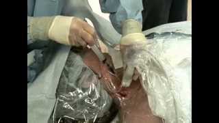 Placement of Central Venous Catheter  NEJM [upl. by Mahalia159]