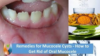 Remedies for Mucocele Cysts  How to Get Rid of Oral Mucocele [upl. by Naujik465]