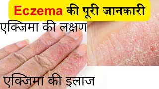 Eczema क्या हैं  Eczema की पूरी जानकारी  eczema kya hota hai  eczema ka ilaj [upl. by Ingamar]