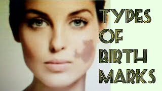 Types of Birthmarks II What are Birthmarks [upl. by Grane]