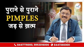 मुँहासे खत्म करने का रामबाण इलाज  How To Remove Pimples Overnight  Acne Treatment amp Medicines [upl. by Chickie]