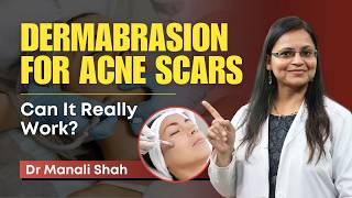 Dermabrasion Acne Scars के लिए Effective  Benefits Procedure and Results  Clear Skin Pune [upl. by Sinegold]