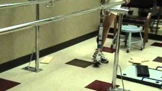 hemipelvectomy Janet SusdorfChadwick 1st day 3rd hour walking on prosthesis [upl. by Fronniah593]