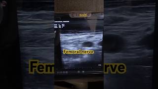 USG guided femoral nerve block femoralnerve anaesthesia usg [upl. by Gebelein]