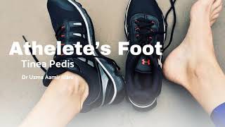 Learn about athletes foot a common fungal infection affecting athletes and nonathletes alike [upl. by Snowber279]