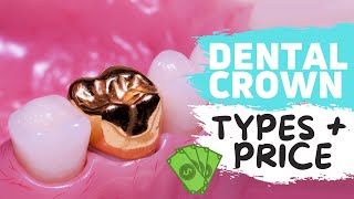 Dental Crowns Explained  WATCH BEFORE YOUR CROWN PROCEDURE [upl. by Lidda]