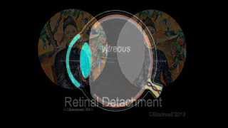 Retinal Detachment [upl. by Mancino]