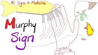 Murphy Sign for Cholecystitis  Signs in Medicine Series [upl. by Alyahs204]