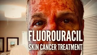 Fluorouracil Skin Treatment  Before During and After [upl. by Ihculo231]