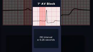 First Degree Atrioventricular Block ECG Example 1 [upl. by Akinom]