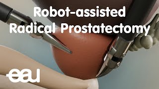 Robotassisted Radical Prostatectomy RARP [upl. by Palla]