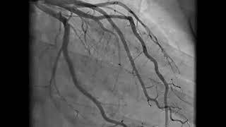 Coronary Angiography  NEJM [upl. by Ydospahr]