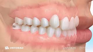 Ortobao Carriere® Clear Motion™ Class II Appliance Maxillary hypoplasia ORTOHERO [upl. by Erma]