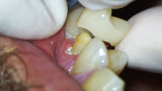 Dental Crown EXPLAINED and how much Tooth Youll Lose [upl. by Aisital]