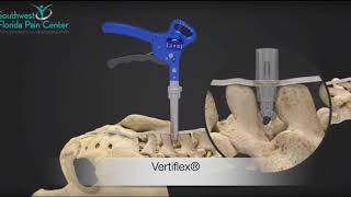 The Vertiflex® Procedure [upl. by Schroer887]