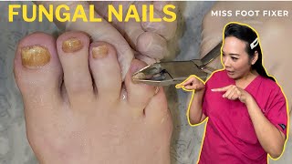 Complete Fungal Nail Treatment A StepByStep Guide  Miss Foot Fixer [upl. by Arahsal407]