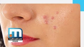 Pimples And Treatment  Doctor2PM Mathrubhumi News [upl. by Harvison594]