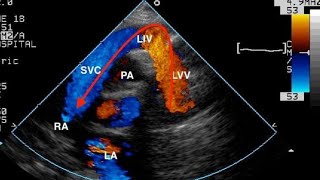 Total Anomalous Pulmonary Venous Return Echocardiography [upl. by Ahsyt]