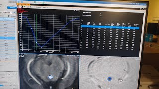 CSF Flow study in Philips3T Detalied explanation in Hindi Pat1avnishradiology [upl. by Ruthe]