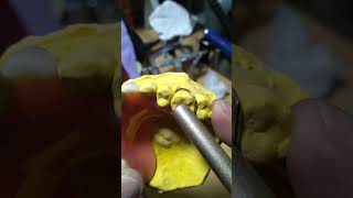 Pustiso na may Kawit Acrylic Denture [upl. by Atiras250]