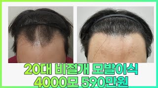 모발이식비용 20대 진행된 M자탈모 비절개4000모 590만원 [upl. by Guttery]