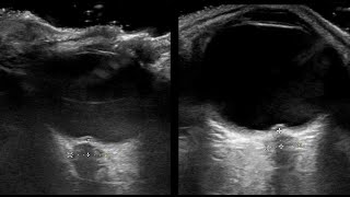 Optic nerve sheath diameter Papilledema Ultrasound Pseudotumor Cerebri 122020 [upl. by Hennebery]