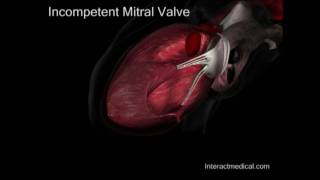 Mitral Valve normal and incompetent [upl. by Perseus]