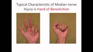 Typical Characteristic of a Median nerve injury [upl. by Mcnutt]