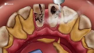 ASMR  rotten teeth cleansing asmr video animation  satisfying asmr animation satisfying [upl. by Airat]