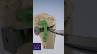 Osteotomy for Osteoarthritis shorts [upl. by Namielus]