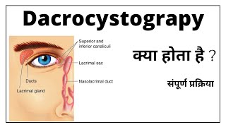 Dacrocystography प्रकिया क्या होती है  और कैसे की जाती है सम्पूर्ण जानकारी [upl. by Rolph]