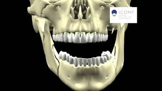 ASIMETRIA MANDIBULAR CIRUGIA MONOMAXILAR [upl. by Jennifer772]