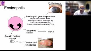 Lecture Vernal Keratoconjunctivitis [upl. by Rowell]