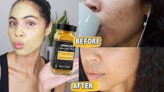 Proof That Turmeric For Acne WORKS and HOW To Use It [upl. by Beore]