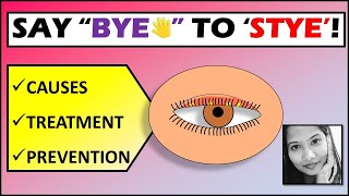 quotGoodbye Styequot  Stye Treatment amp Prevention  External Hordeolum [upl. by Eimmij690]