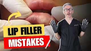 6 Lip filler Mistakes Injectors Make [upl. by Pliske225]