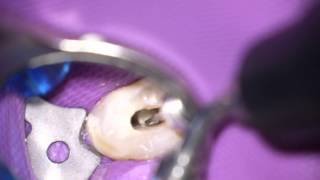 Ultraschall in der Endodontie [upl. by Naquin]