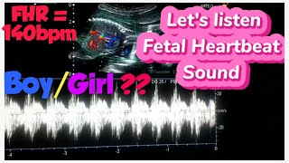 Baby heartbeat sound on ultrasound  heart rate boygirl  Fetal doppler heartbeat sound [upl. by Yrtua]