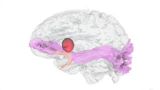 3Dimensional Reconstruction of Dominant Hemisphere Gliomas [upl. by Arikihs]