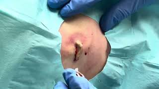 Cyst Incision amp Drainage [upl. by Phylis]