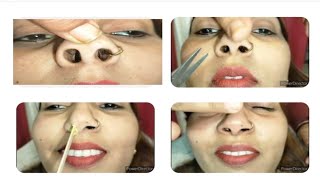 Nose hair cuttingkaise kare nose hair cuttingnosehaircutting pignose ​⁠pummybeautyworld [upl. by Llenhoj]