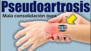 PSEUDOARTROSIS o Mala Consolidación de FRACTURAS 🥵 Falsa Articulación 🔴 Dr EDSON SERRANO Neomedica [upl. by Naicul559]