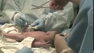 Twins Birth by Cesarean nongraphic  emergency delivery of multiples attended by doula [upl. by Corliss]