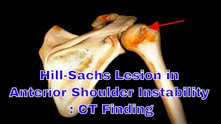 HillSachs Lesion in anterior shoulder instability  CT Finding [upl. by Chessy154]