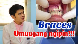 BRACES GUMAGALAW NA NGIPIN Pwedeng mauwi sa bunot Masakit [upl. by Naji]